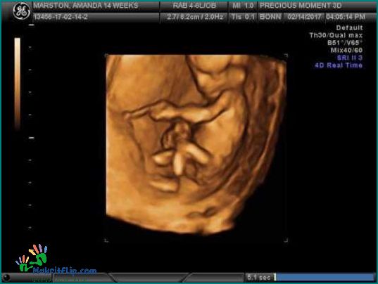 3D Ultrasound at 13 Weeks What to Expect and Benefits