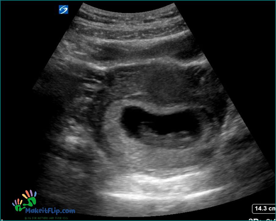 5 Week Ultrasound Twins One Sac - What You Need to Know