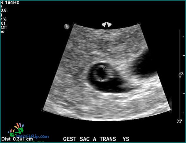 5 Week Ultrasound Twins One Sac - What You Need to Know