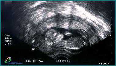 7 Week Ultrasound What to Expect and What It Can Reveal