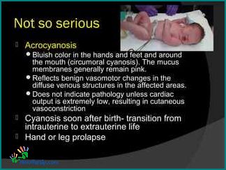 Acrocyanosis in Newborns Causes Symptoms and Treatment