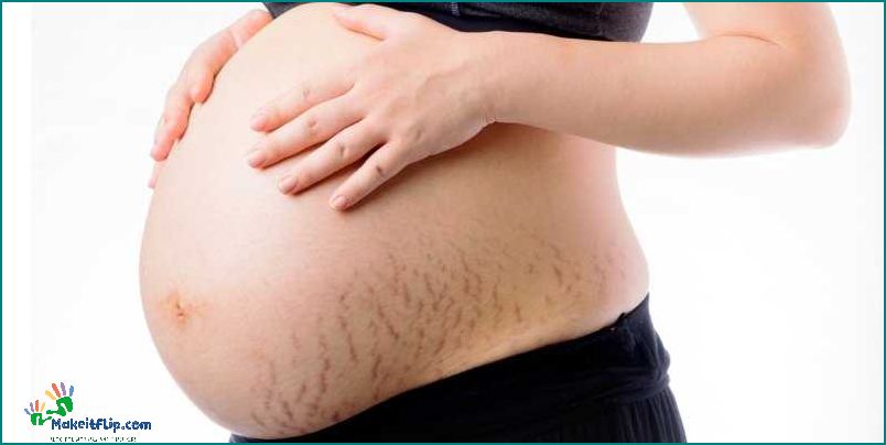 Are Stretch Marks Genetic Exploring the Role of Genetics in Stretch Mark Formation