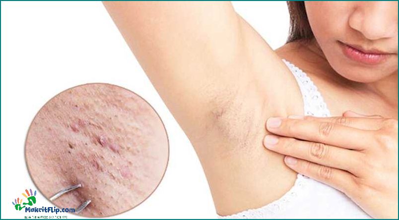 Armpit Pimple Causes Treatment and Prevention
