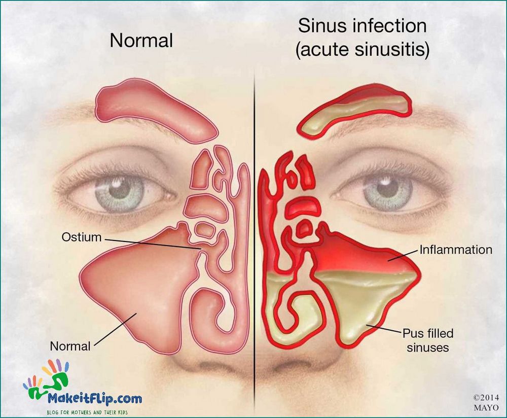 Sinus Infection While Pregnant Causes Symptoms and Treatment