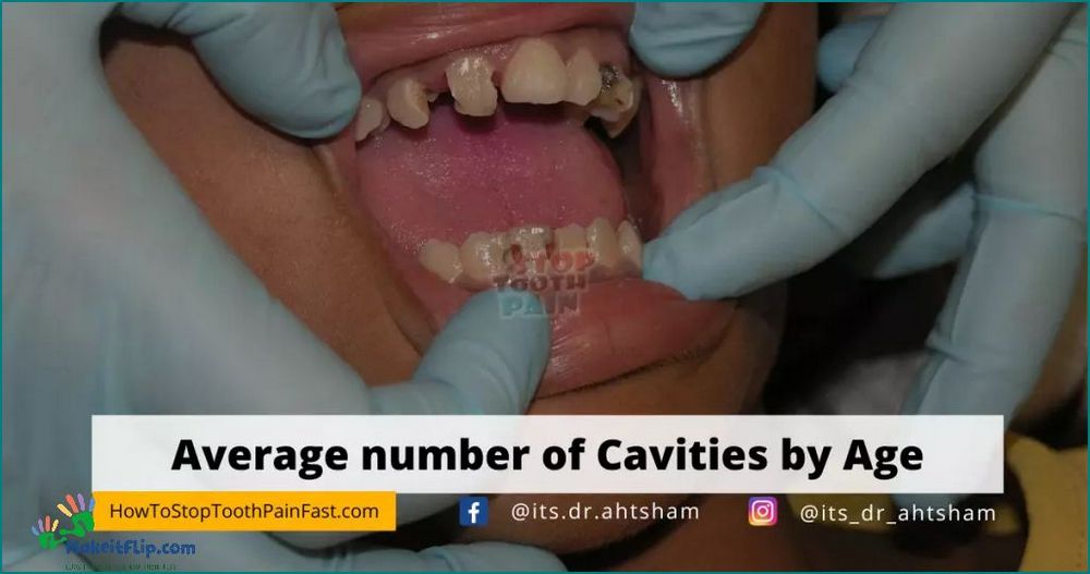 Average Number of Cavities by Age 30 What You Need to Know