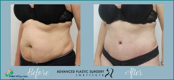 Tummy Tuck Before and After Pregnancy Restoring Your Pre-Baby Body