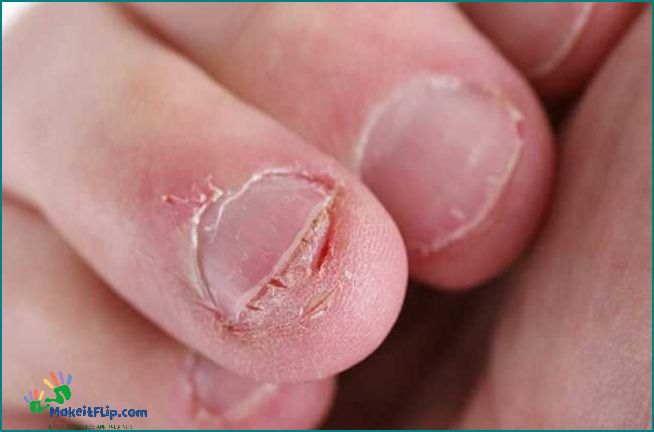 Biting Fingers Causes Symptoms and Treatment