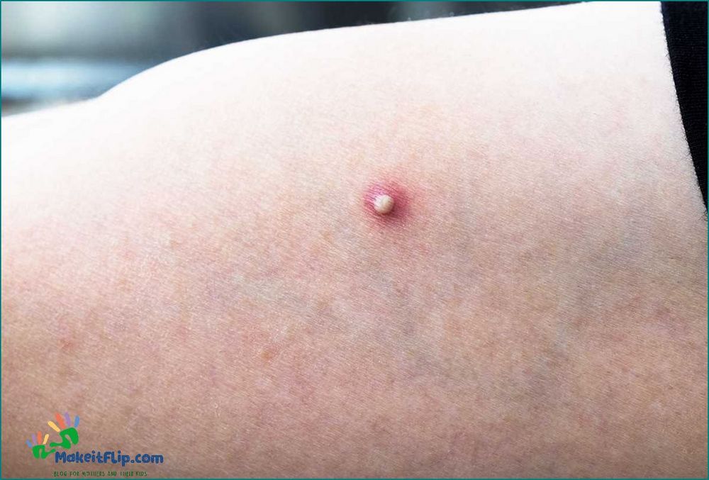 Bump on Inner Thigh Causes Symptoms and Treatment