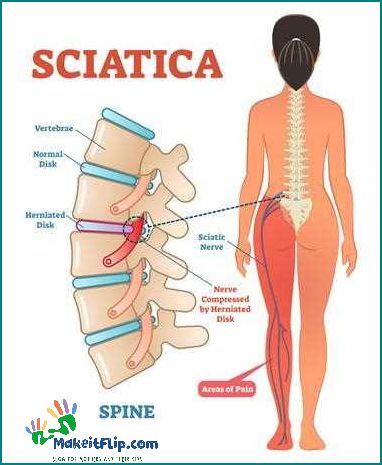 Can Sciatica Cause Hip Pain Understanding the Connection