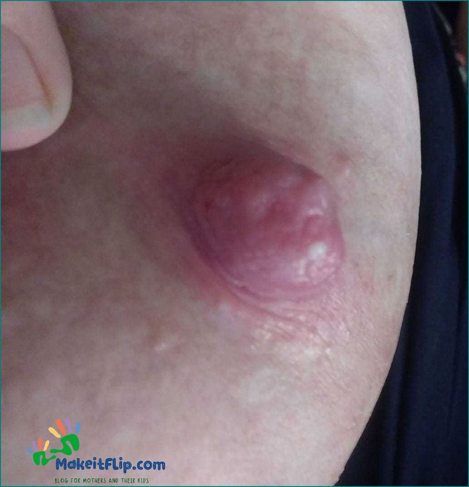 Causes and Treatment of Blood Blister on Nipple While Breastfeeding