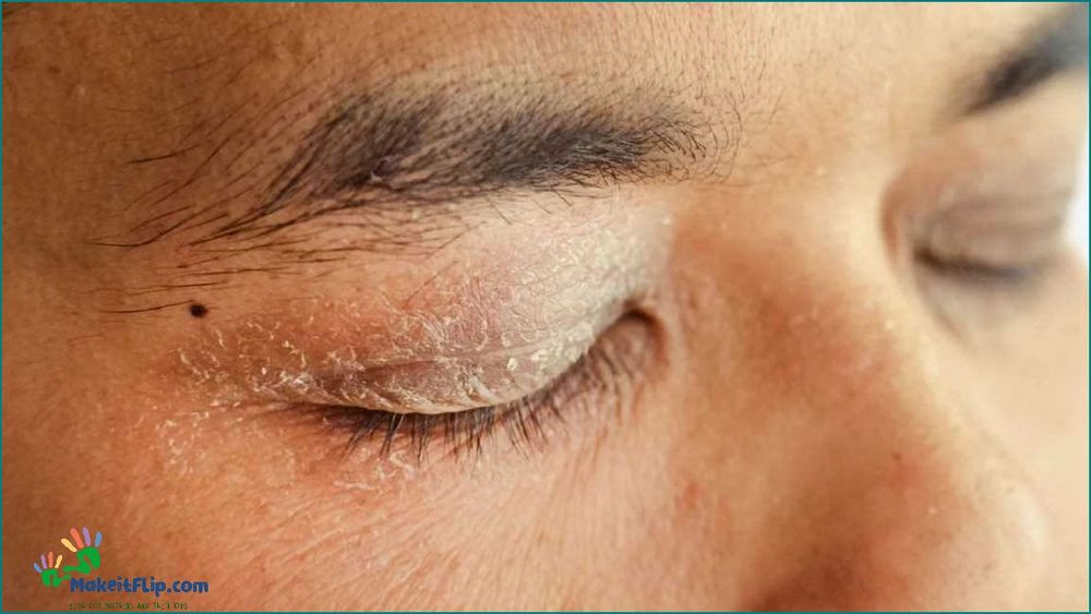 Causes and Treatments for Red Dry Skin Around Eyes | Expert Advice