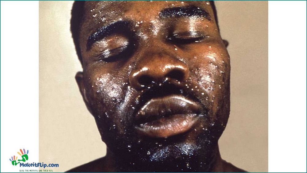 Chicken Pox Black Skin Causes Symptoms and Treatment