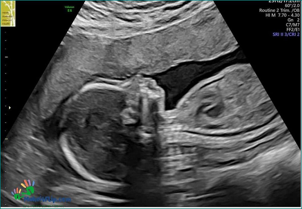 Cleft Lip Ultrasound at 20 Weeks What You Need to Know