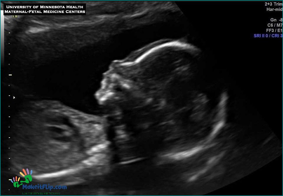 Cleft Lip Ultrasound at 20 Weeks What You Need to Know