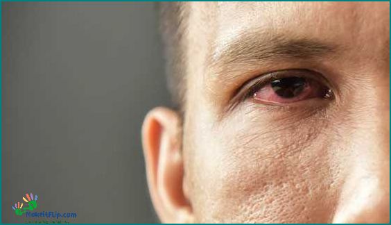 Cold in Eye Causes Symptoms and Treatment | YourSiteName