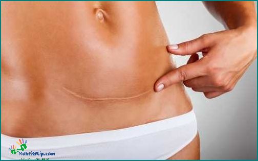 Csection Scar Removal Effective Methods and Tips