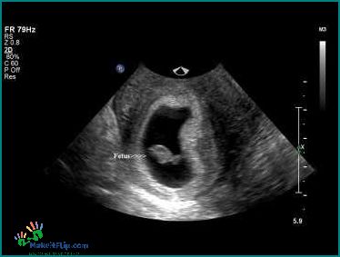 How to Determine the Location of the Placenta on Ultrasound