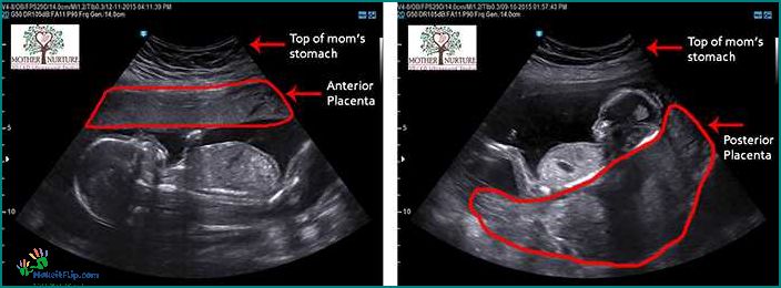 How to Determine the Location of the Placenta on Ultrasound