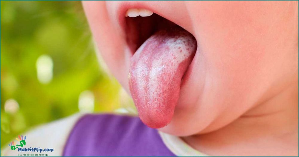 Milk Tongue vs Thrush Understanding the Difference and How to Treat Them