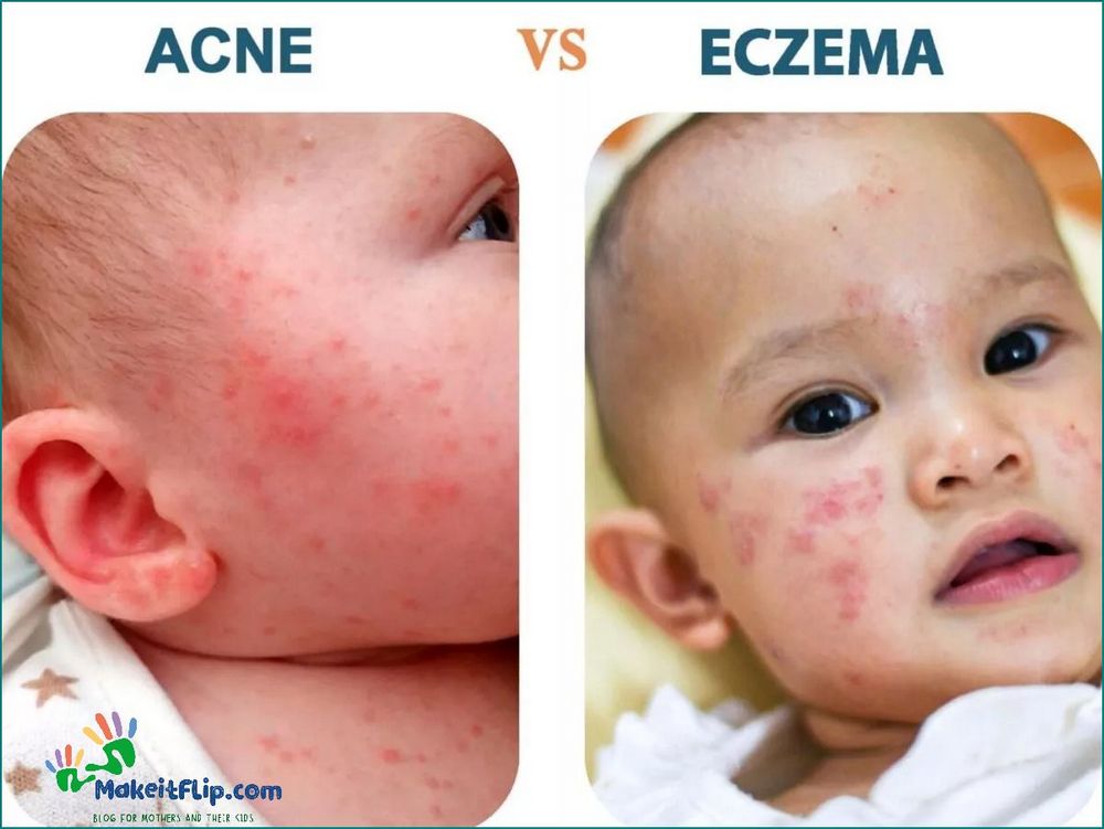 Baby Acne vs Eczema Understanding the Difference and How to Treat Them