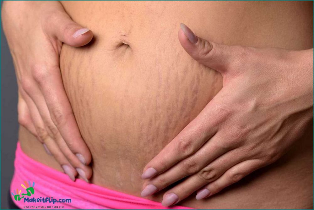 Do Stretch Marks Become More Visible When You Lose Weight