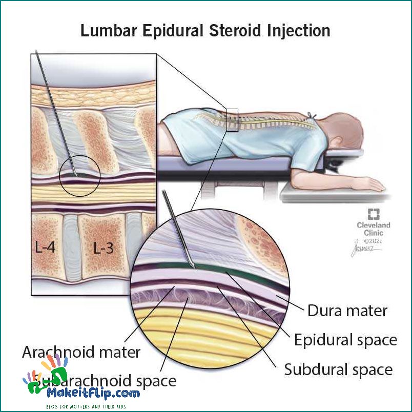 Epidural vs Spinal Understanding the Differences and Benefits