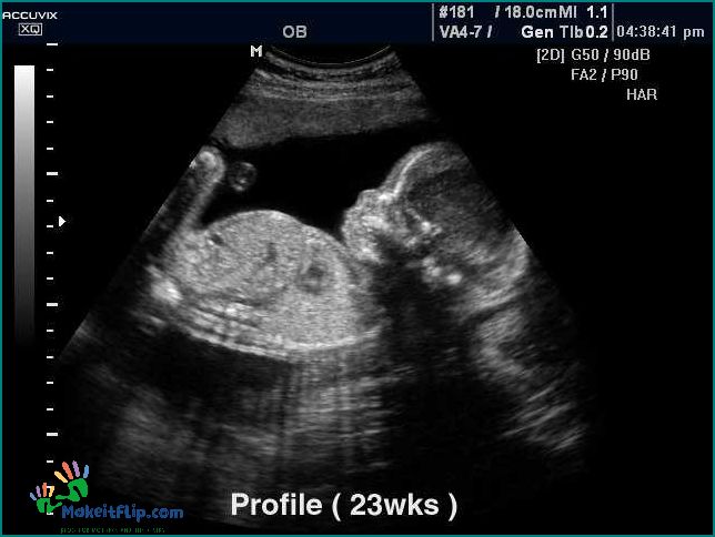 Everything You Need to Know About 23 Week Ultrasound