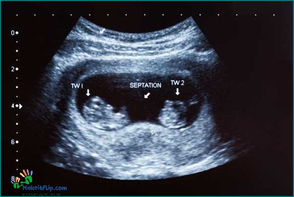 Everything You Need to Know About 8 Week Ultrasound