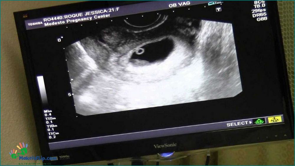 Everything You Need to Know About 8 Week Ultrasound