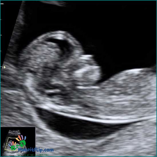 Everything You Need to Know About the 12 Week Ultrasound