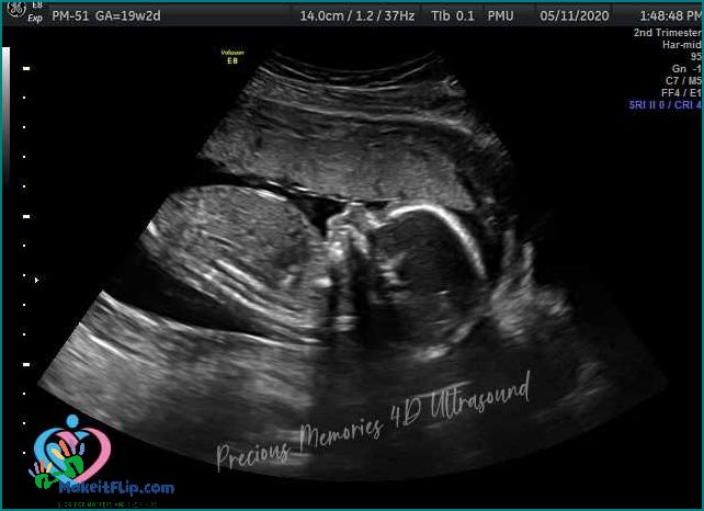 Everything You Need to Know About the 16 Week Ultrasound