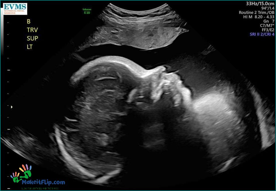 Everything You Need to Know About the 32 Week Ultrasound