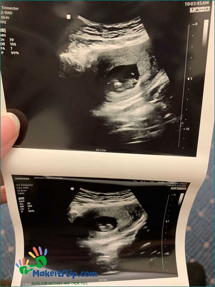 10 Weeks Pregnant Ultrasound What to Expect and What It Looks Like