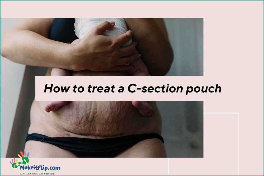 Get Rid of Your C Section Pouch with These Effective Tips