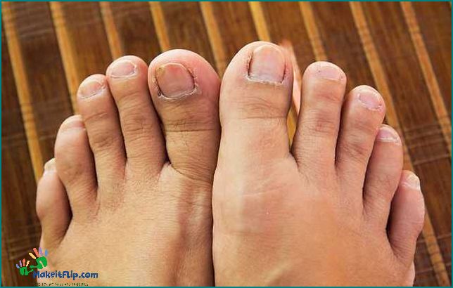 Gross Toes Causes Treatment and Prevention