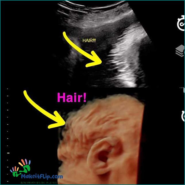 Hair on a 3D Ultrasound What Can You See