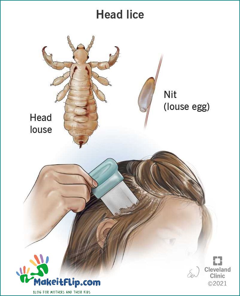Head Lice Pictures Identifying and Treating Head Lice Infestations