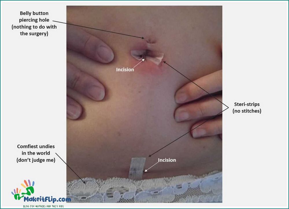 Healed Tubal Ligation Scars Understanding the Recovery Process