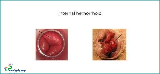 Hemorrhoids Perineum Causes Symptoms and Treatment Options