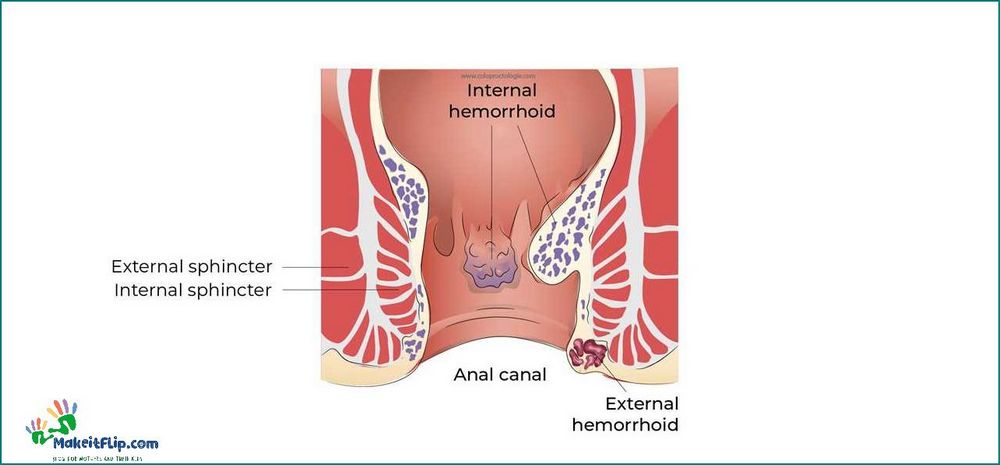Hemorrhoids Perineum Causes Symptoms and Treatment Options