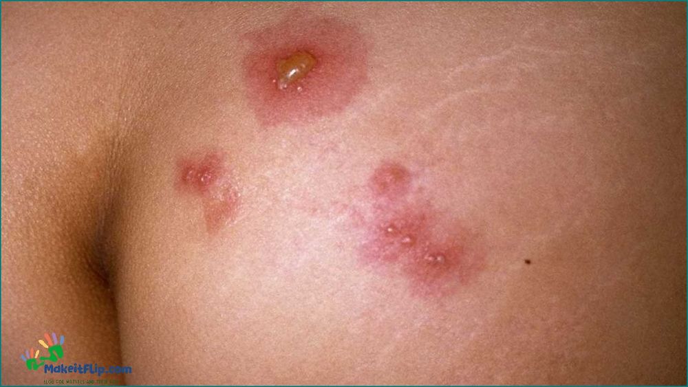 Herpes on Butt Crack Causes Symptoms and Treatment