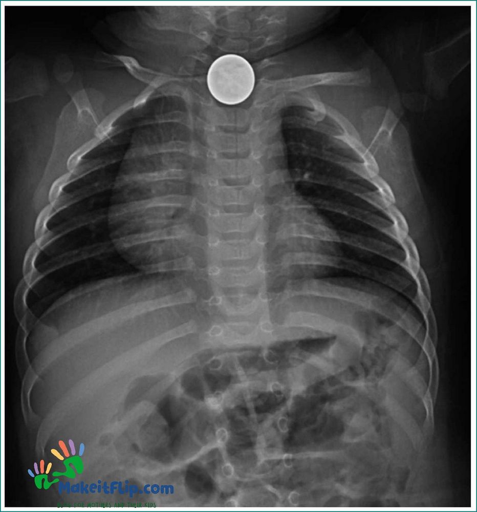 How Long Does It Take for a Child to Pass a Swallowed Coin