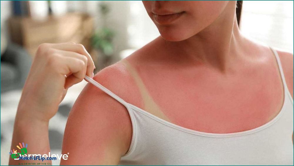 Hydrocortisone for Sunburn Benefits Usage and Precautions