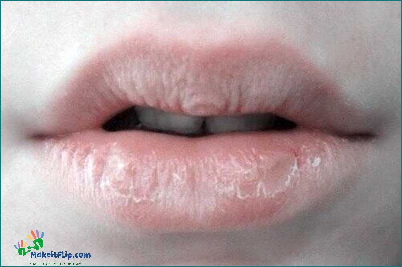 Dry Lips During Pregnancy Causes Symptoms and Remedies
