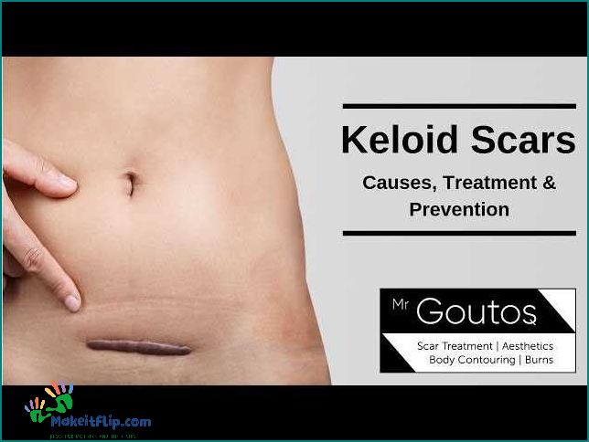 Keloid C Section Scar Causes Treatment and Prevention