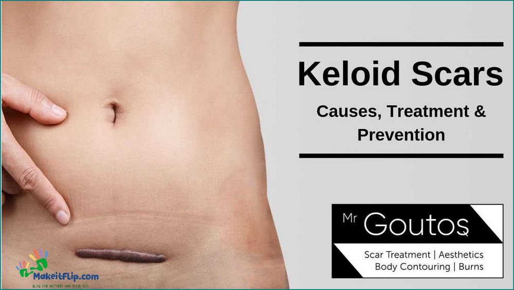 Keloid C Section Scar Causes Treatment and Prevention