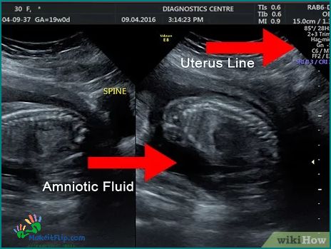 Learn How to Read an Ultrasound A Comprehensive Guide