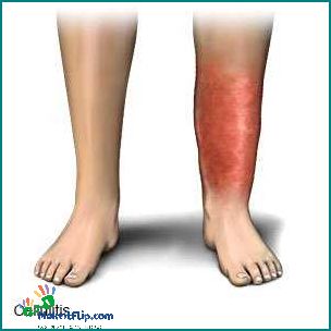 Leg red Causes Symptoms and Treatment