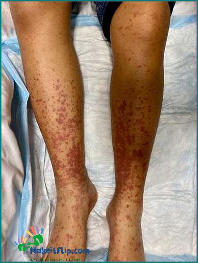 Leg red Causes Symptoms and Treatment