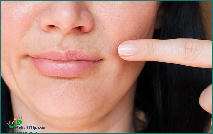 Lip Acne Causes Treatment and Prevention